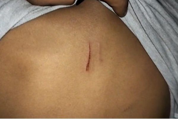 Oknum Kades Muaro Bungo Diduga Melakukan Pemukulan Terhadap Remaja Hingga Luka